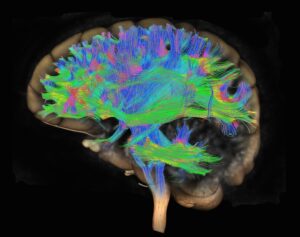 brain scan with the use of DTI (diffusion tensor imaging)